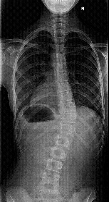 image of spine with small curvature - X-ray